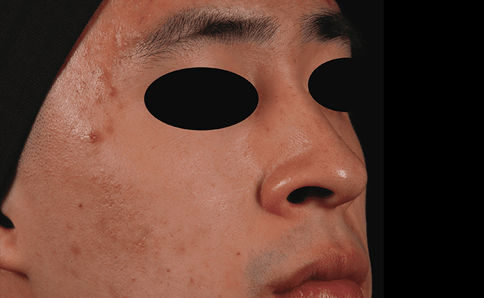 AviClear Acne Treatment Before After Denver Boulder 6