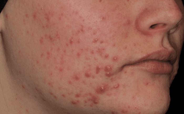 AviClear Acne Treatment Before After Denver Boulder 1