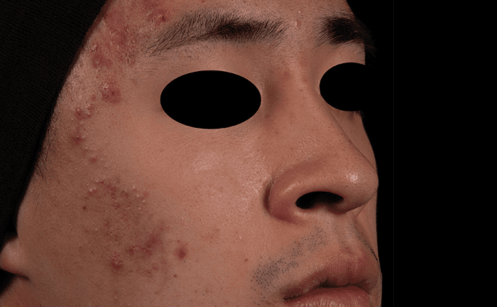 AviClear Acne Treatment Before After Denver Boulder 5