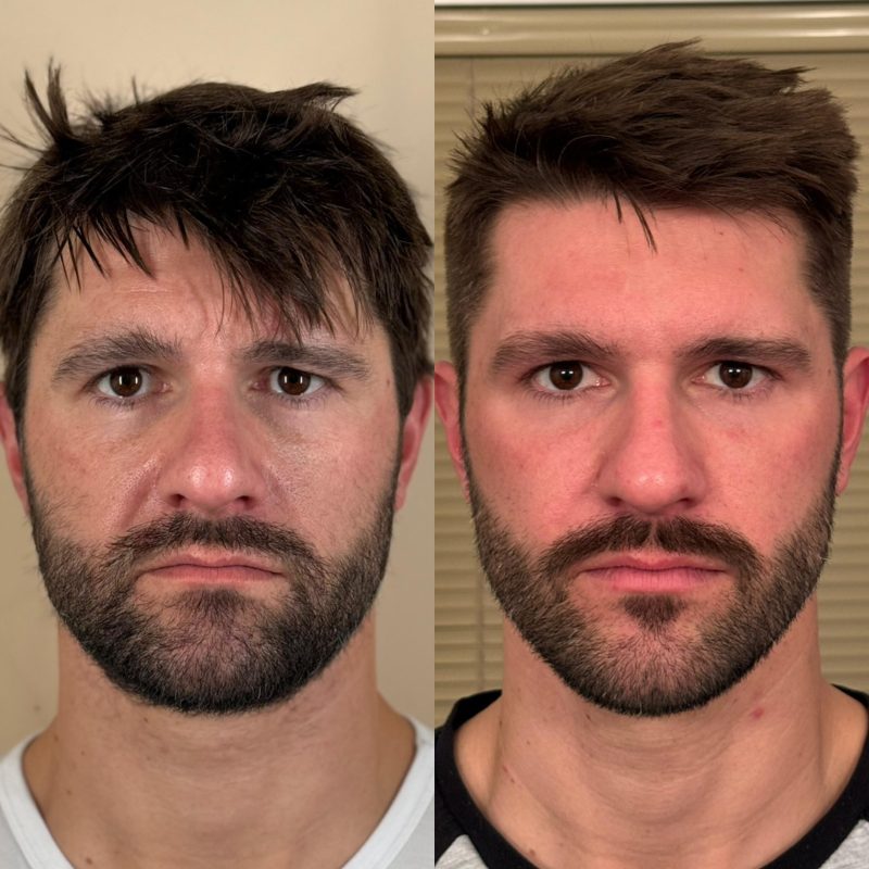 mens-botox-results-denver-colorado (1)